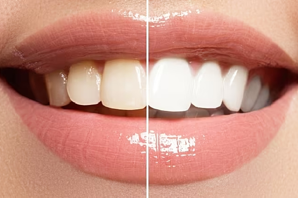 Bright & White Smile